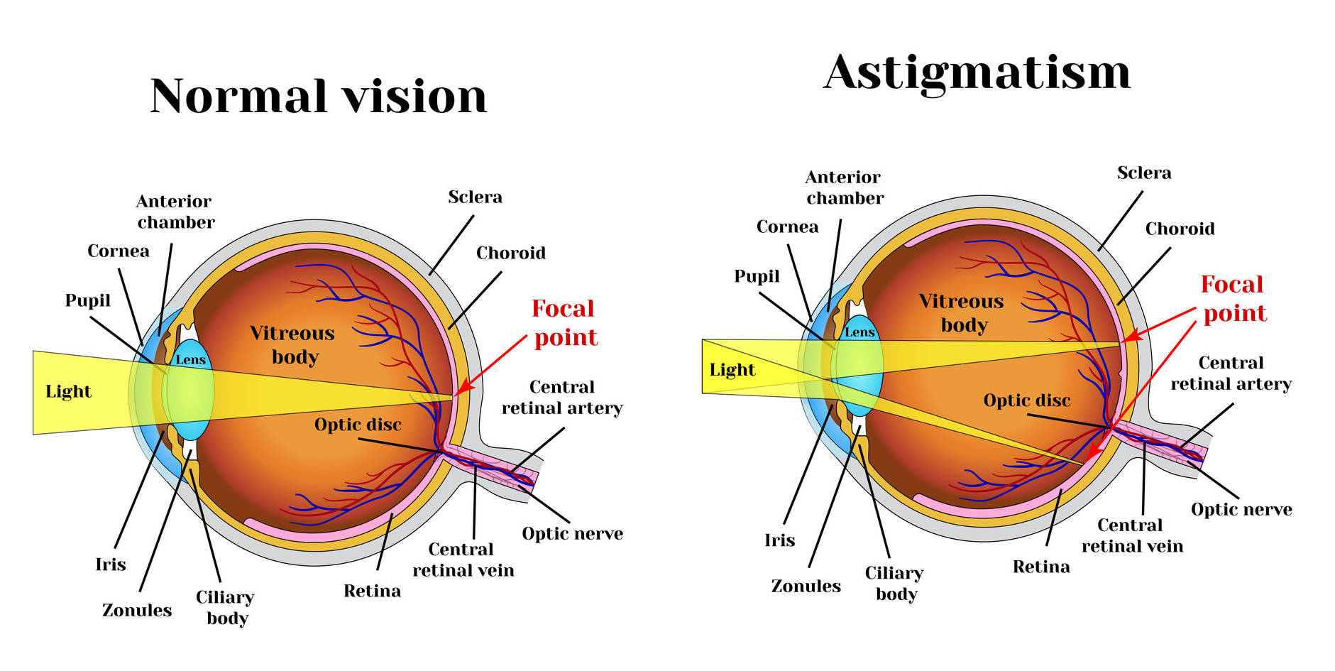 bateseyeexercises-astigmatism-exercises