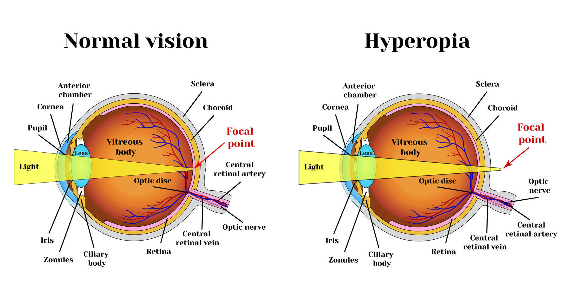 bateseyeexercises-hyperopia-exercises