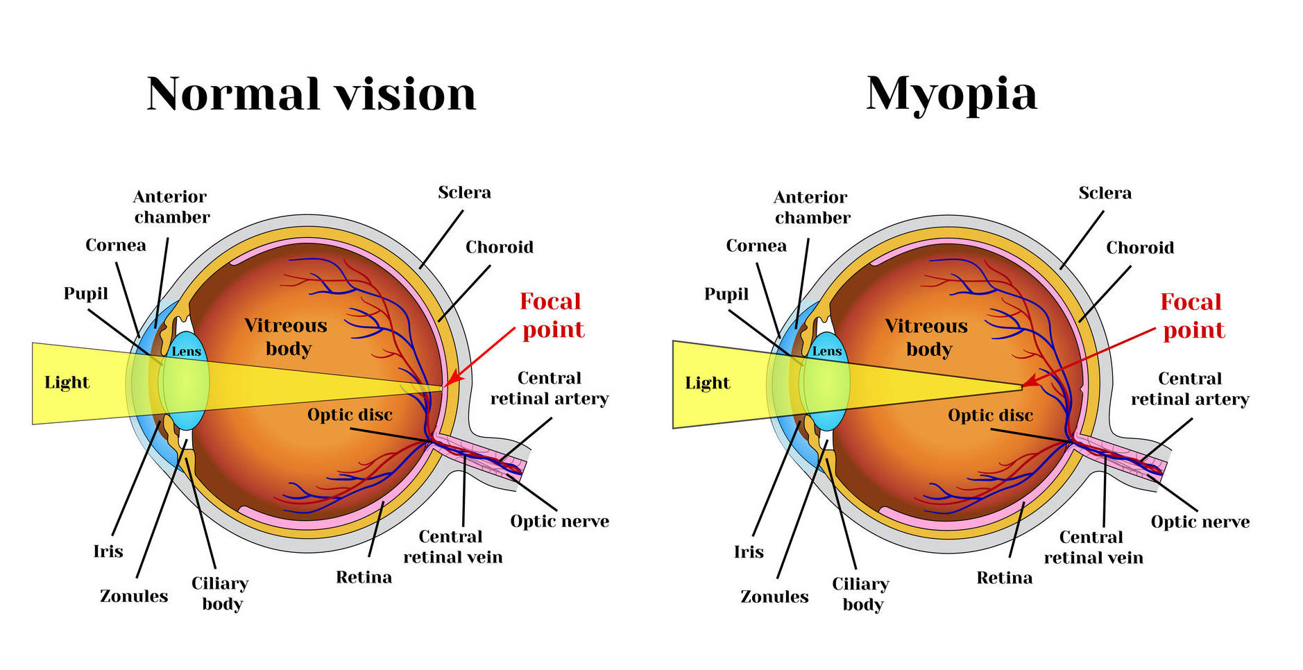 BatesEyeExercises.com === Myopia Exercises